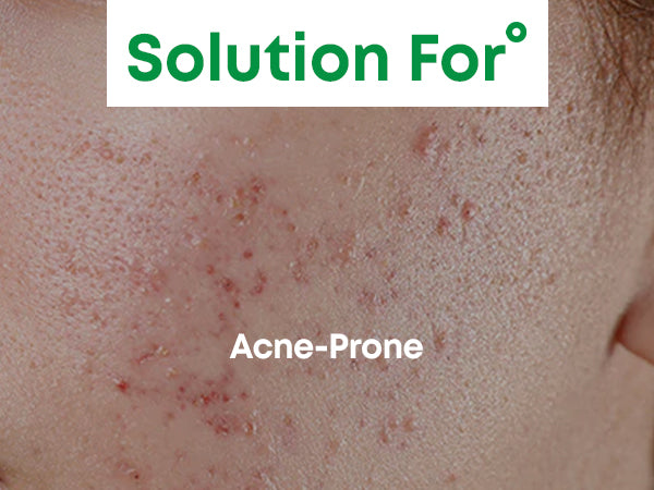 [NINE LESS] A-Control 10% Azelaic Acid Serum