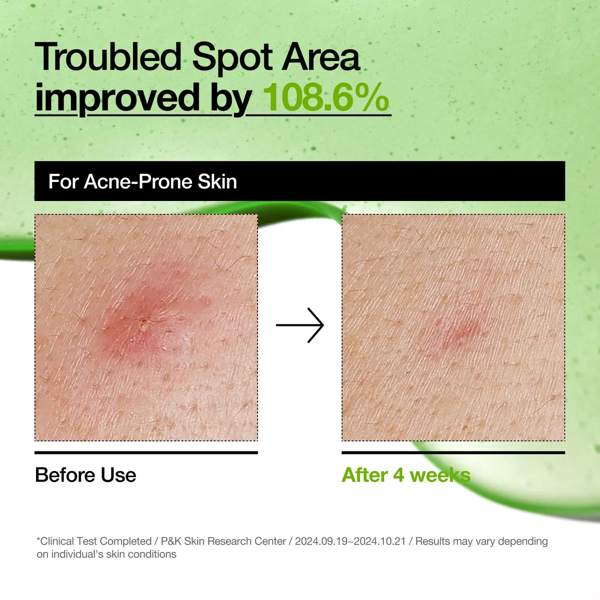 [Anua] Azelaic Acid 10 Hyaluron Redness Soothing Serum