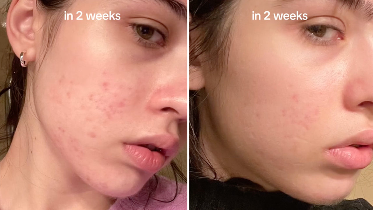 [Anua] Niacinamide 10% + TXA 4% Dark Spot Correcting Serum 30ml